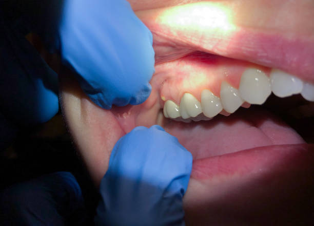 Best Emergency Tooth Extraction in Mcdonough, GA