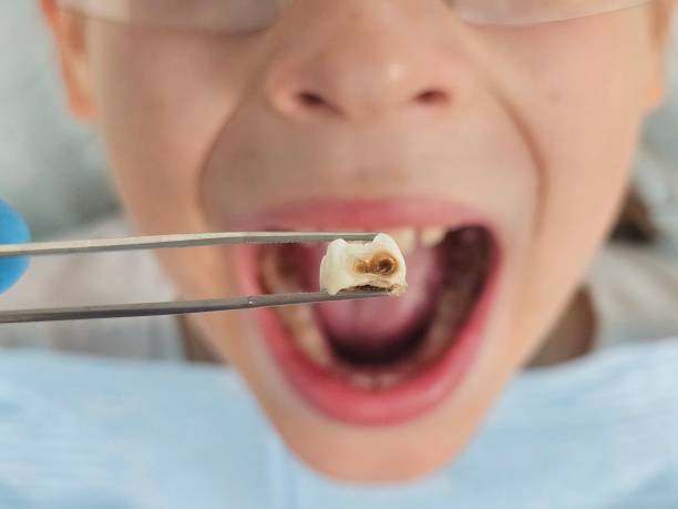 Best Emergency Treatment for Dental Infections or Abscesses in Mcdonough, GA